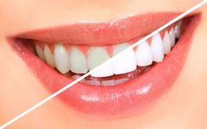 Envie d’un sourire éclatant ? Notre soin blanchiment dentaire vous permet de gagner de 3 à 7 teintes...